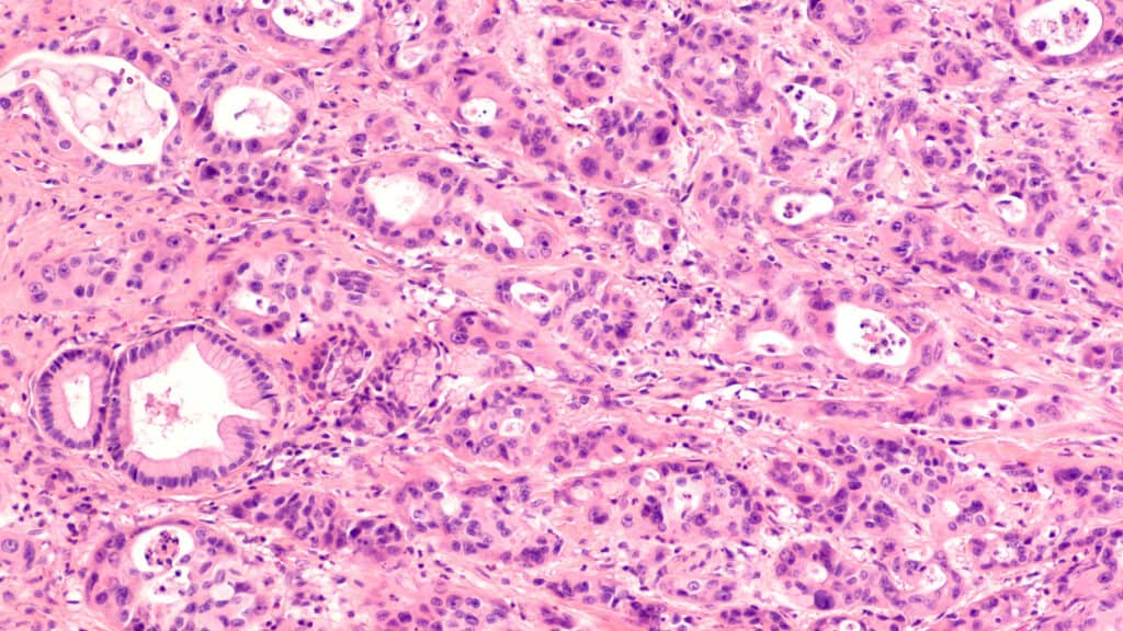 Slide showing pancreatic cancer cell. 