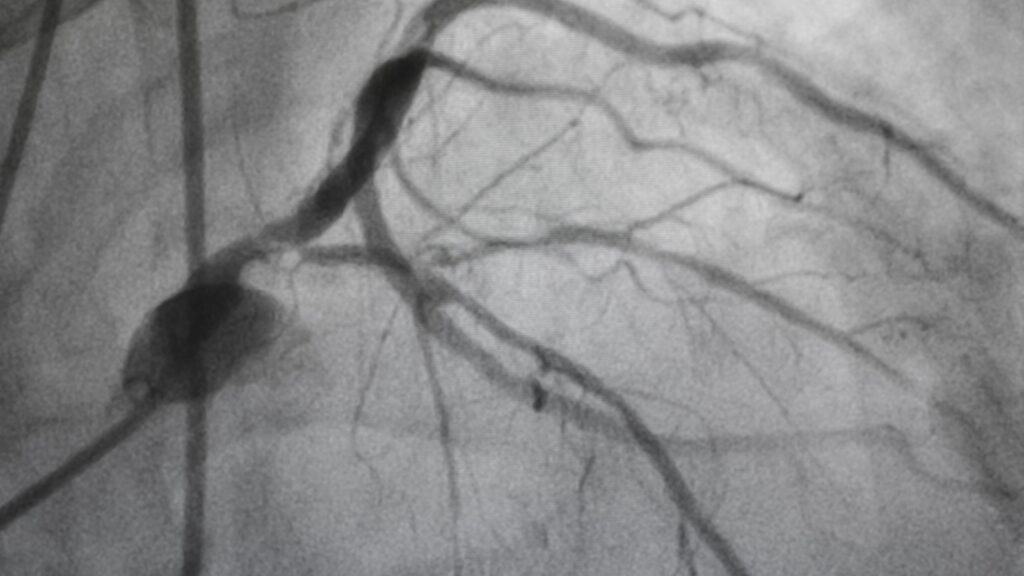 Angiography. 