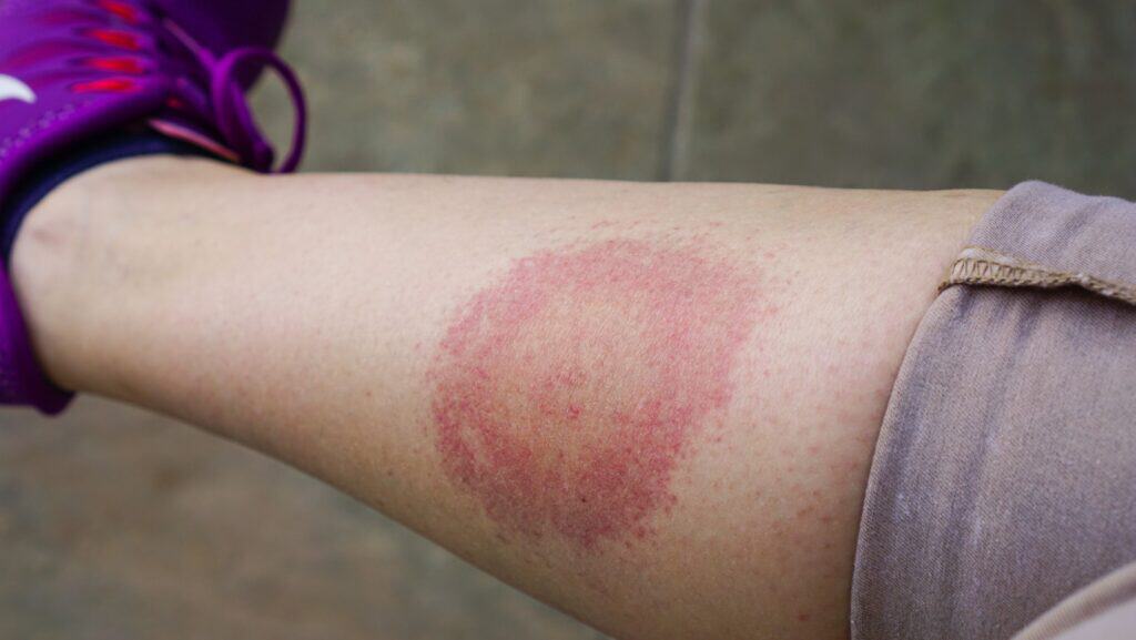 tick. Lyme rash. 