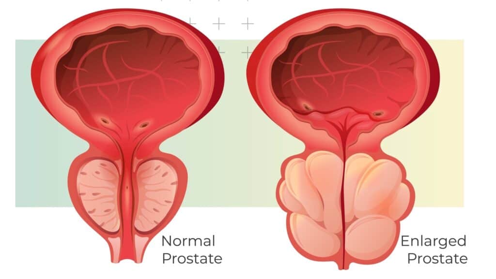 prostate diagram. 